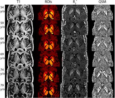 Iron load in the normal aging brain measured with QSM and R2* at 7T: findings of the SENIOR cohort